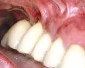 Befestigte Gingiva Schutz von Zähnen und Implantaten Im gesunden Parodont werden die Zähne von einem ca. fünf Millimeter breiten Band befestigter Gingiva umschlossen.