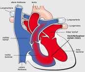 Herzerkrankungen Herzkranzgefässe: Arteriosklerose