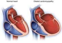 Herzmuskelerkrankungen, Herzinsuffizienz