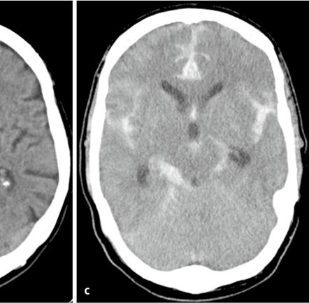 Auch eine bereits demarkierte ausgedehnte Ischämie stellt eine Kontraindikation der Thrombolyse dar.