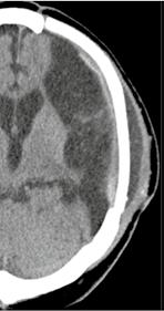 b Kranielle CT nach dekompressiver Hemikraniektomie links mit rückläufiger Mittellinienverlagerung. Vorwölbung des infarzierten Hirnparenchyms aus dem Trepanationsdefekt.