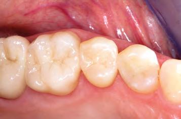20: Beispiel für geeignete Polierinstrumente zur intraoralen Bearbeitung von ZLS-Keramiken. Abb. 21: Zustand zwei Wochen nach adhäsiver Befestigung der Restaurationen.