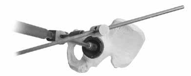 Anterior inferior Einsetzen des endgültigen Implantats Die Pfanne kann auch mit Hilfe des Ausrichtungsstabes oder A-Rahmens positioniert