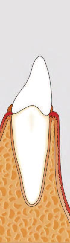 Entstehung einer Parodontitis I Gingiva-Erkrankungen 1 Entstehung einer Gingivitis 2 Entstehung einer Parodontitis I 3 Entstehung einer Parodontitis II Gesundes Zahn fleisch