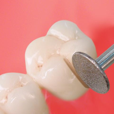 Cabinet Dentaire Dental Practice Zahnarzt - Praxis Entfernen einer Vollkeramik - Restauration (Kronentrenner) Für die Entfernung einer Vollkeramik-Restauration muss die Restauration entlang der