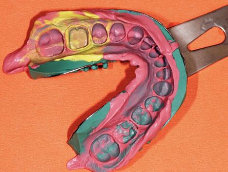 Damit gleitet die Abformung an der Zahnachse des präparierten Stumpfes entlang. Im Unterkiefer ist dies genau umgekehrt.