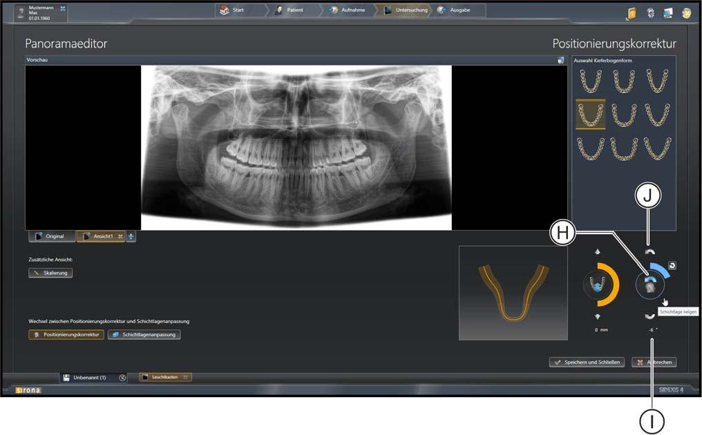 3 Panoramaeditor bedienen Sirona Dental Systems GmbH 3.2 Positionierungskorrekturen durchführen Addendum zum "Handbuch für den Anwender SIDEXIS 4" SIDEXIS 4 3.2.3 Kopfneigung anpassen Für das Anpassen der Kopfneigung haben Sie verschiedene Möglichkeiten.