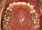 375 Abb. 3 OPG bei Behandlungsplanung. ist ein entzündungs- und kariesfreies Gebiss Voraussetzung für den Beginn der kieferorthopädischen Zahnbewegung.