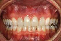 10 a, b Extraorale Lippenansicht und intraorale Ansicht nach restaurativer Versorgung mit Veneers auf den Zähnen 12, 22 durch den zahnärztlichen Kollegen Dr. med. dent. Rolf Burbach, Köln. Retainer.
