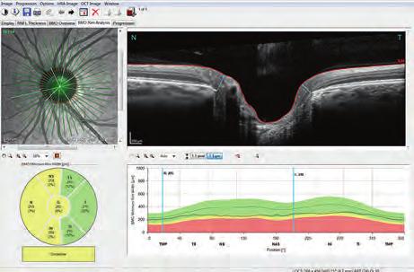 Die OCT-Untersuchung Strukturen des Sehnervenkopfes Die Optische Kohärenz Tomographie, auch OCT genannt, ist ein modernes, bildgebendes Verfahren zur
