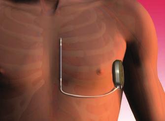 Elektrode parallel zum Brustbein Impulsgeneratorverbindung linke Seite des Brustkorbs Abbildung 5.