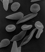 Sichelzellanämie Mutation im β -Globingen Autosomal rezessiv, d.h. Erkrankte sind in Bezug auf die Mutation homozygot Die roten Blutzellen verformen sich bei Sauerstoffarmut zu sichelförmigen