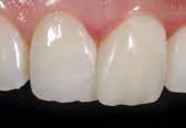 Unterstützung in besonderen Situationen 4 opake Dentinfarben ermöglichen hochästhetisches Arbeiten im