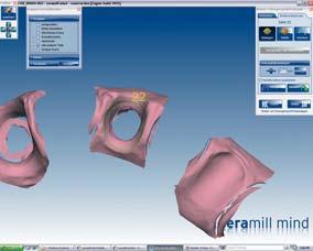 dd TECHNIK DIGITALE ZAHNTECHNIK Abb. 4 Eingescannte und virtuelle Scankörper werden in Deckung gebracht Abb. 5 Der obere Rand des Emergenzprofils wird festgelegt Abb.