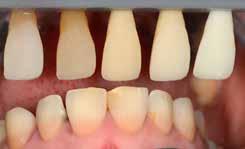 Adult MD DE Restaurierung tetracyclinverfärbter Zähne mit Eine 50-jährige Patientin beklagte sich über die Ästhetik ihrer oberen Frontzähne.