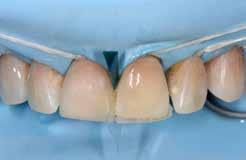 In einem nächsten Schritt wurde der bukkale Zahnschmelz durch die Farbe Dark Enamel (DE) ersetzt.