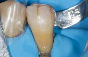Dentin (DD) und Dark Enamel (DE) reproduziert. Die Zähne wurden mit Hilfe eines Kofferdams isoliert.