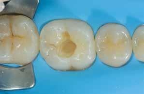 Da Dentin im Seitenzahnbereich tendenziell stark chromatisch ist, während der Zahnschmelz ein eher weißliches Aussehen hat, entschied man sich für den Einsatz der Zweifarbschichttechnik Posterior