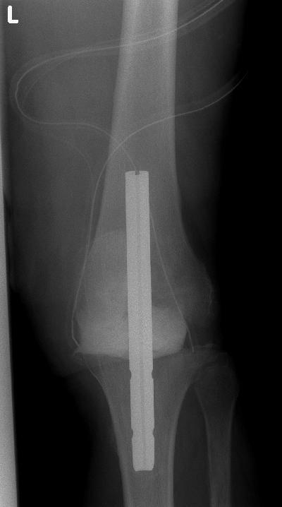 Abb.8: Röntgenaufnahme Knie links