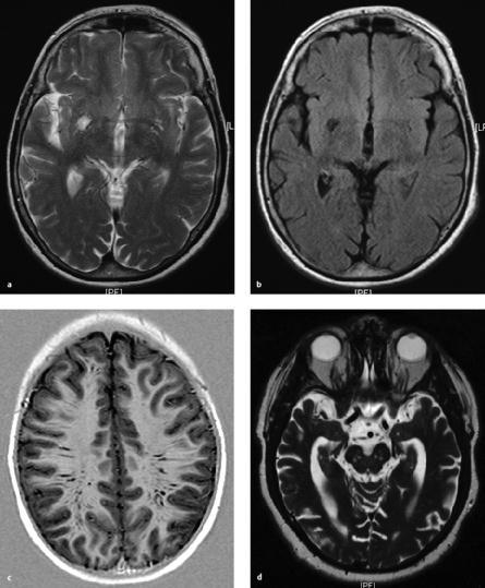 2.1 Zerebrale Ischämie Abb. 2.5 Virchow-Robin-Raum. a Axiales T2w Bild mit deutlich sichtbaren Virchow-Robin-Räumen, rechts noch größer als links. b FLAIR-Bild (gleicher Patient wie in a).