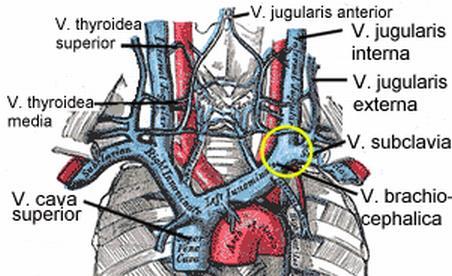 1. Vena jugularis interna am Hals 2. Vena subclavia unter dem Schlüsselbein 3. Vena basilica am Arm 4.