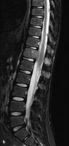 DD: Hodgkin-Lymphom, Plasmozytom, Langerhans- Zell-Histiozytose, Leukämie, Osteomyelitis. Szintigrafie: Positive Befunde nur bei Knochenumbau (z. B. Arrosion), dann im Regelfall in der Mineralisationsphase.