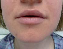 Lippenaugmentation
