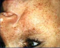 Altersflecken (medizinisch auch Lentigo senilis oder Lentigo solaris genannt) zählen wie Muttermale und Sommersprossen zu den Pigmentflecken der Haut. Sie entstehen durch langjährige UV-Bestrahlung.