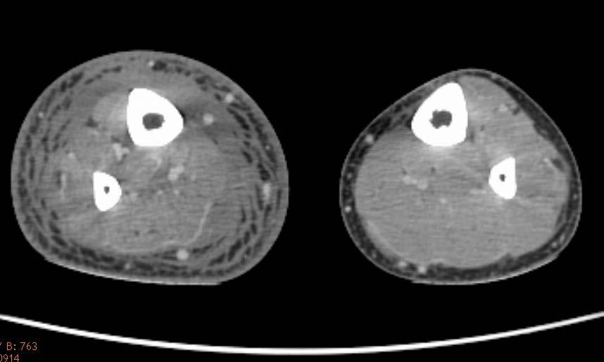 Hinweise auf Oedem und Entzündung Fall C - CT CT Bild des Unterschenkels.