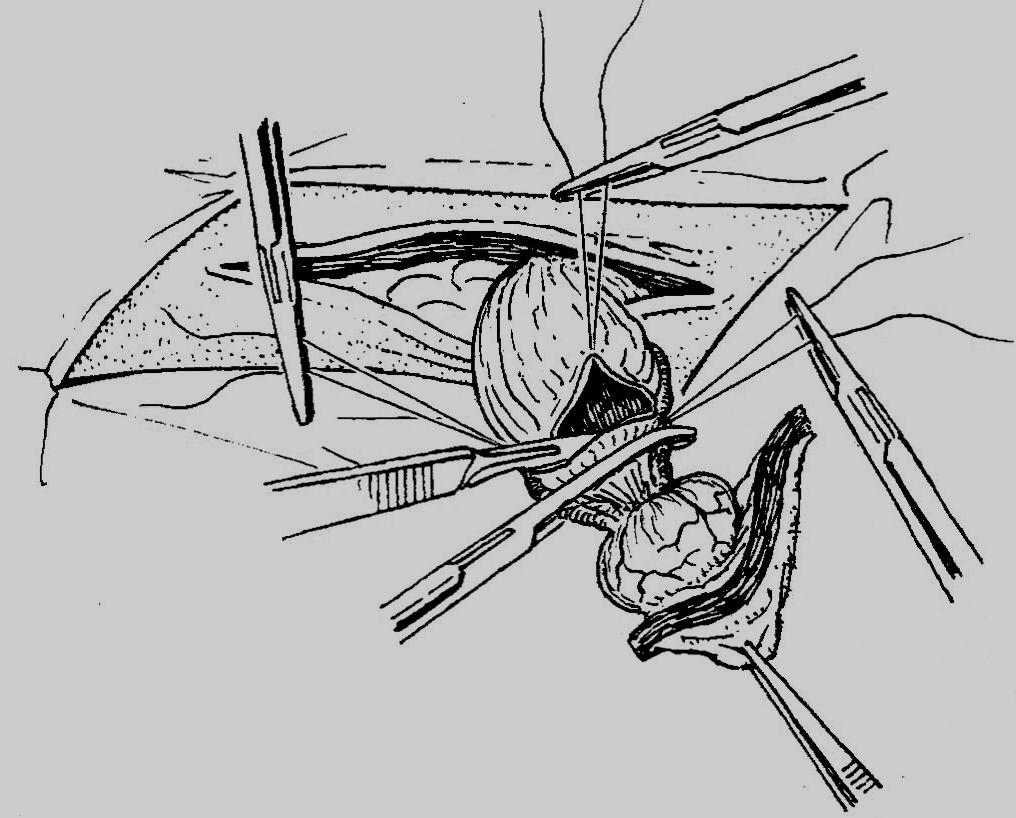 Zystoplastie Operation Ligatur der