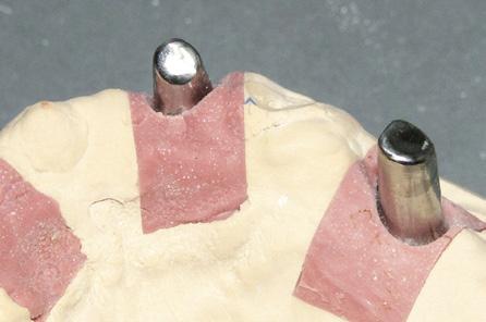 Abb. 15: Vollanatomische Zahnformen nach Modifikation. Abb. 12: auf dem Sägeschnittmodell.