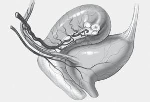 pudenda interna können bei der vaginalen sakrospinalen Fixation verletzt werden, eine seltene, aber potenziell problematische Komplikation. Die A.