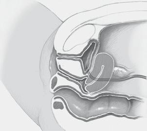 Bei der rekonstruktiven Beckenbodenchirurgie ist oft eine Gewebedissektion bis zum Perineum bzw. den Levatorbäuchen (z. B. bei der Sakrokolpopexie) sowie lateral bis zum M. obturatorius internus (z.
