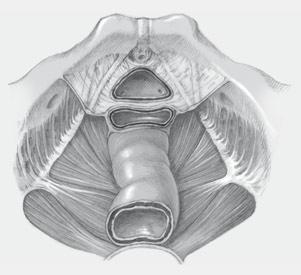 -4 Bild nach subtotaler Entfernung der Harnblase: Die enge Verbindung zwischen Arcus tendineus fasciae pelvis (), Fascia pubocervicalis (= Fascia pelvis, ) und vorderer