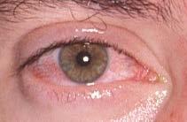 Dringliche Augennotfälle Uveitis Das Auge schmerzt bei Lichteinfall und wenn ich in die Nähe schaue Ein Auge ist rot und die Pupille