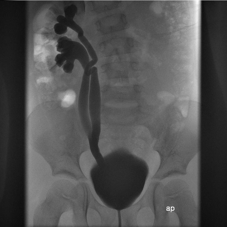 Abbildung 9: Hochgradiger VUR mit intrarenalem Reflux bei Doppelniere rechts mit Ureter fissus 1.6. Spontaner Verlauf des vesikoureterorenalen Refluxes 1.6.1. Spontanmaturation Der VUR kann im Verlauf spontan ausreifen.