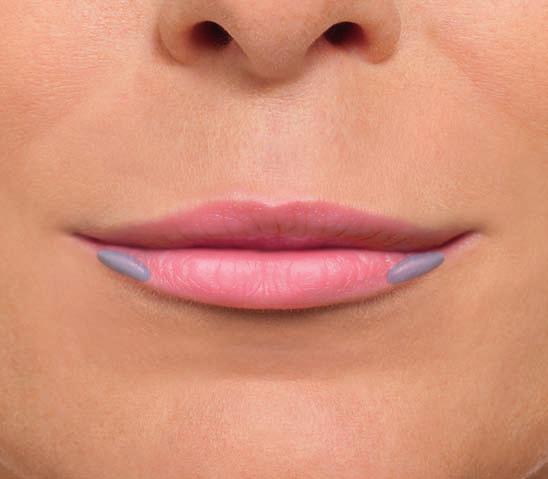 Gesichts. 6 Punktionsstelle ( ) Die erste Injektion erfolgt über der Spitze des Mundwinkels.