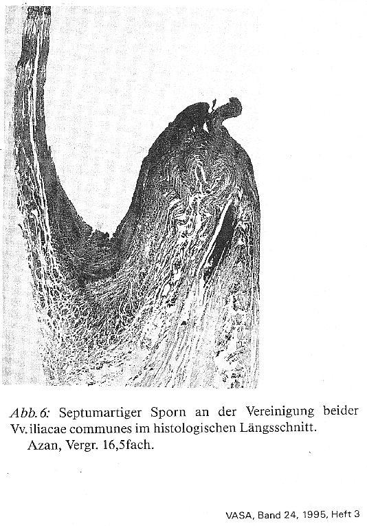 504 8. Beckenvenensporn (May-Thurner-Syndrom) R. May und J.
