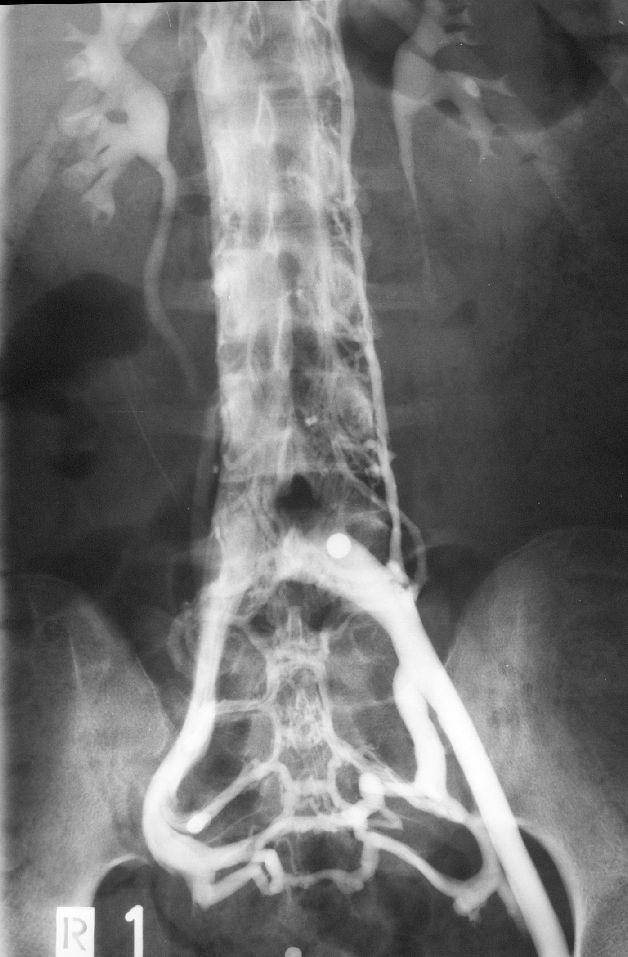 lumbalis ascendens mit ausgeprägter Kontrastierung der paravertebralen und spinalen Venen des Abdominalraums.