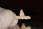extrahierten natürlichen Zahnes Für die temporäre Versorgung nach dem Setzen eines Implantates während der Osseointegration des Implantates