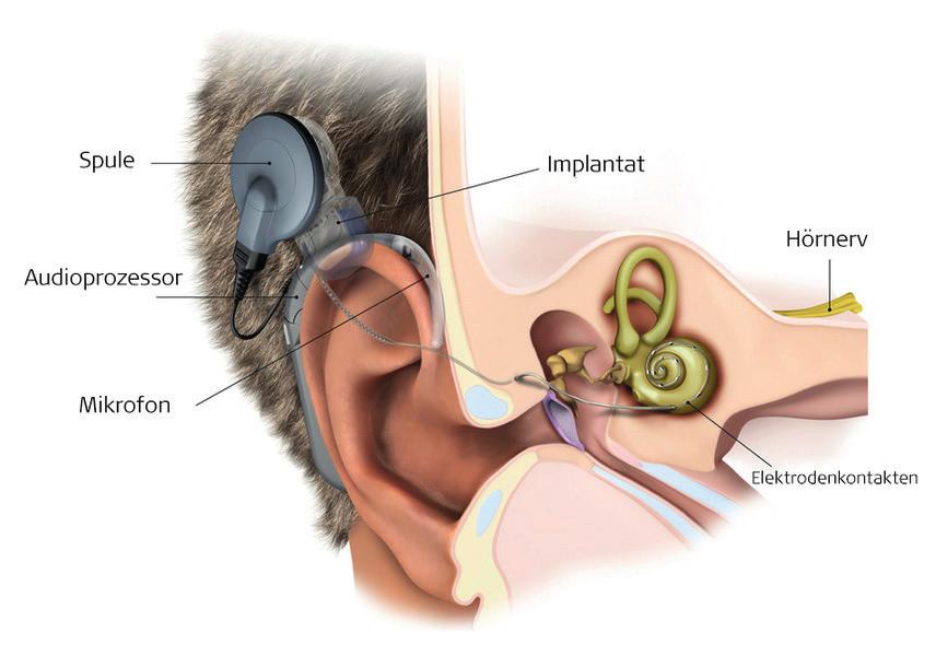 Das Chochlea-Implantat (CI) Bei hochgradig schwerhörigen und gehörlosen Kindern reicht die Versorgung mit Hörgeräten nicht aus.