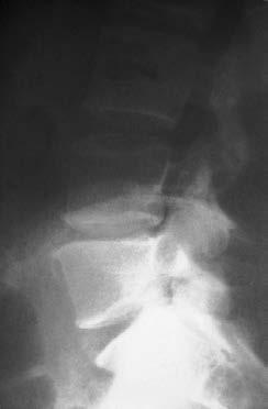 Foraminotomie) Revisionseingriff nach erfolgloser Bandscheibenoperation, bei rezidivem Bandscheibenvorfall und bei postoperativen Instabilitäten Degenerative Spondylolisthese Grad I oder II