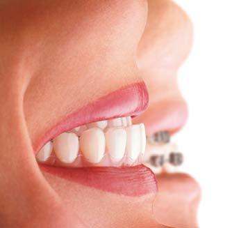 Aligner sind hauchdünne, weiche Kunststoff-Schienen, mit denen Zähne sanft in die gewünschte Position bewegt werden.