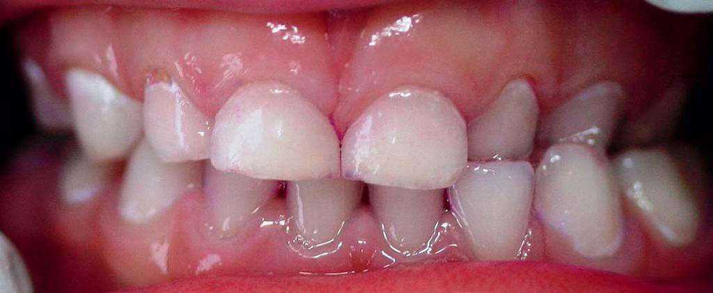 12 Zahnmedizin Abb. 2: Einseitiger Kreuzbiss im Milchgebiss. spange (Multiband) durchgeführt. Bei bestimmten Zahnfehlstellungen sollte allerdings eine Frühbehandlung in Betracht gezogen werden.