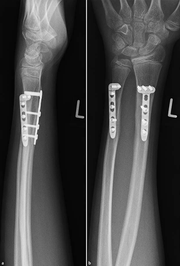 202 Röntgenspezialeinstelltechnik bei distalen Unterarmfrakturen Pronation und Supination.