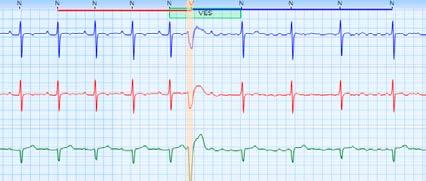 Klicken Sie auf das ECHOView-Fenster, und die entsprechenden EKG-Kurven werden zur Auswertung der Hinweise auf Vorhofflimmern oder -flattern angezeigt.
