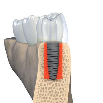 Orofaziale Implantatposition Die faziale und palatinale Knochenschicht muss mindestens 1 mm dick sein, um stabile Hart- und Weichgewebebedingungen sicherzustellen.