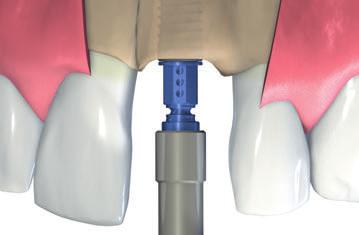 Das Bone Level Tapered Implantat wird am besten so gesetzt, dass der äussere Rand der kleinen, 45 abschrägten Fase auf Knochenniveau liegt.
