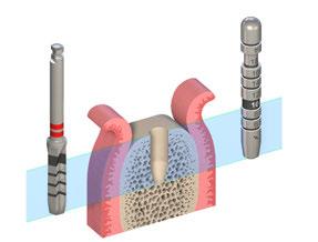 500 U/min Schritt 4 Erweiterung des Implantatbetts auf 3,5 mm Erweitern Sie das Implantatbett mit dem BLT Bohrer 3,5 mm.