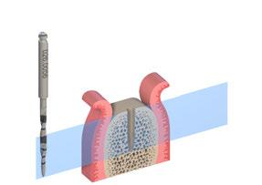 Markieren Sie die während der Planung der Implantatposition festgelegte Implantationsstelle mit dem Rosenbohrer 1,4 mm und/oder dem Nadelbohrer 1,6 mm.